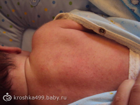 Что такое щетинка у новорожденных и как его лечить Что такое щетинка у новорожденных и как его лечить